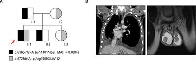 PIEZO1 Hypomorphic Variants in Congenital Lymphatic Dysplasia Cause Shape and Hydration Alterations of Red Blood Cells